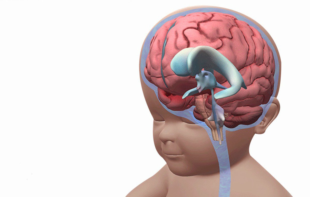 Creierul și hidrocefalia. Cauzele emoționale ale ei.