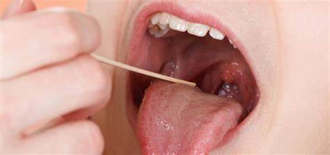 Amigdalita și cauzele emoționale ale ei.