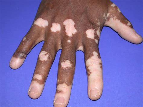 Vitiligo, mai mult decât o afecțiune a pielii? Cauzele emoționale.