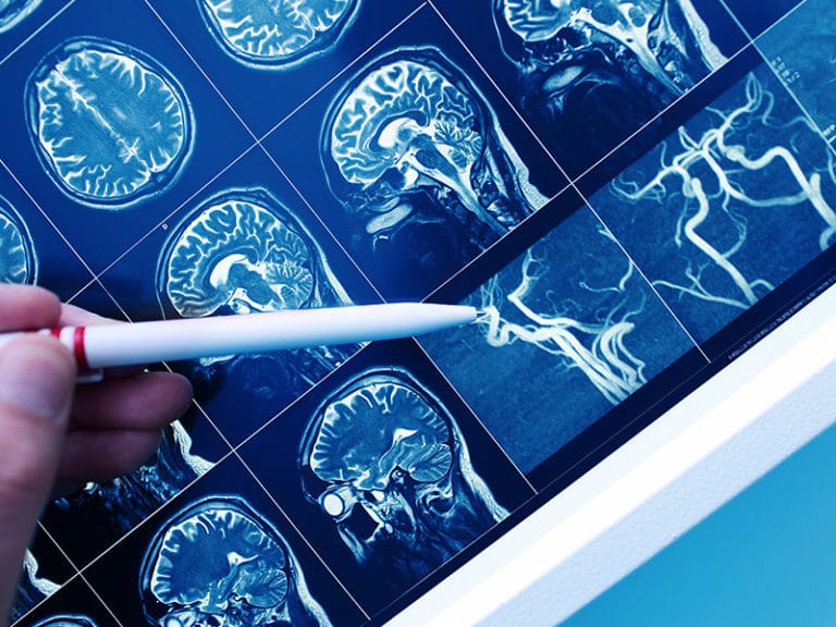 Creierul și epilepsia. Cauzele emoționale ale epilepsiei.