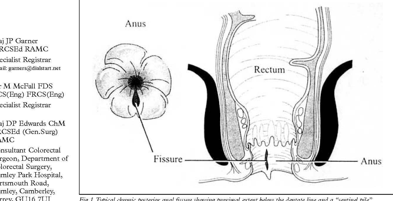 Fistule Anale. Cauze emoționale