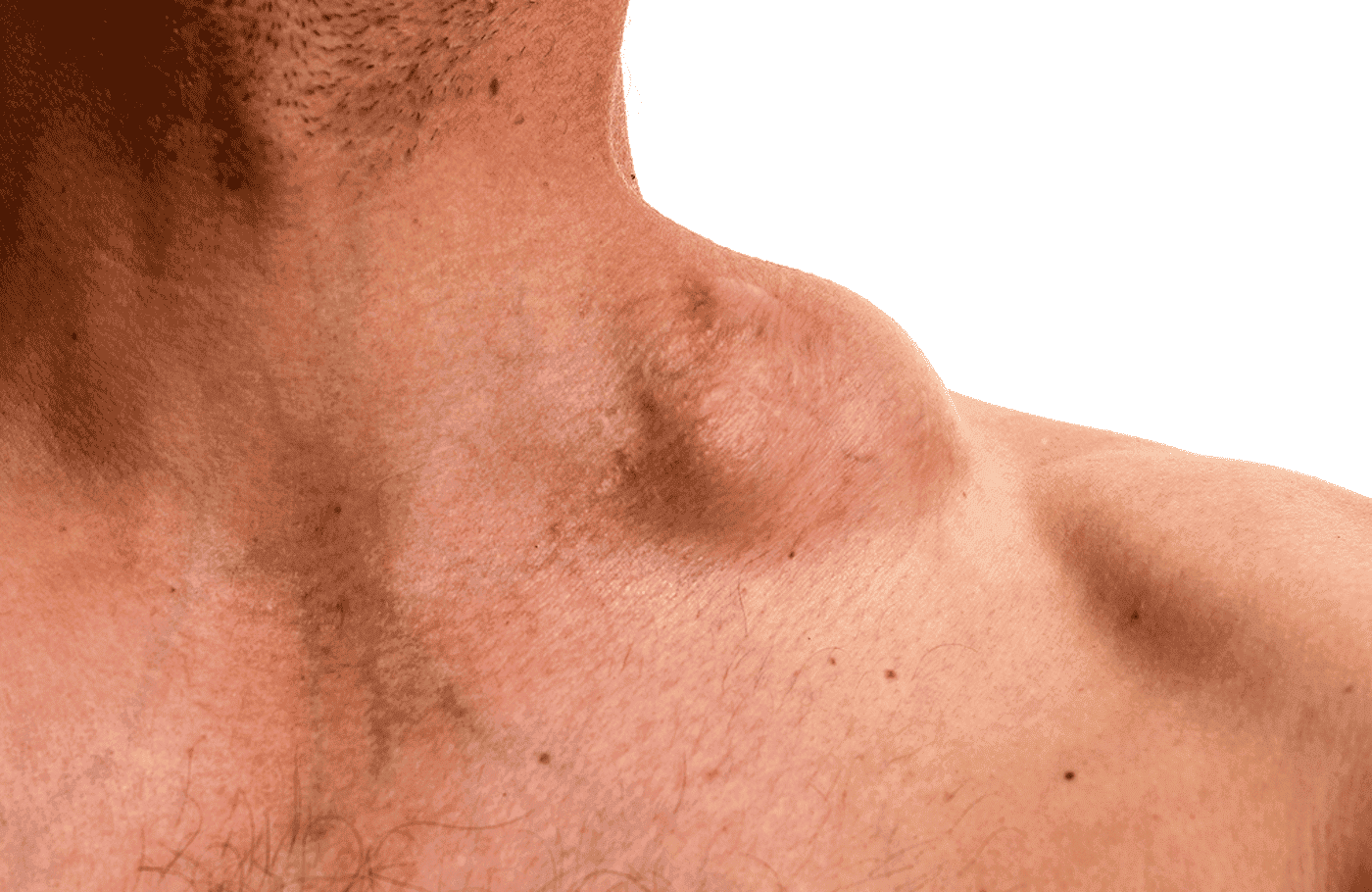 Cancerul la Ganglionii Limfatici. Cauzele emoționale