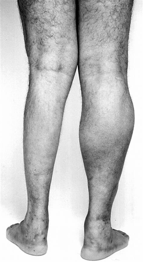 Atrofia din punct de vedere emoțional