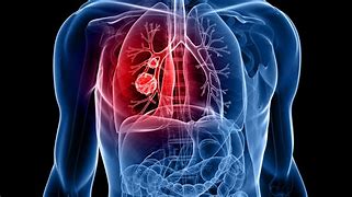 Cancerul la Plămâni și cauzele emoționale