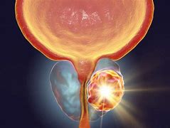 Cancer la testicule. Cauza emoțională