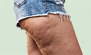 Celulita și cauzele emoționale ale ei