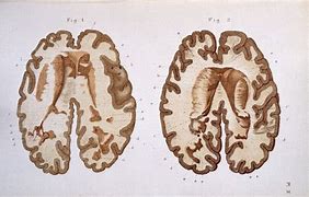 Boala lui Charcot și cauzele emoționale