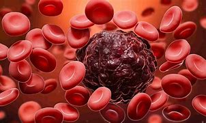 Cancerul de sânge și cauzele emoționale