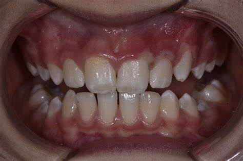 Gingii – Gingivită Acută