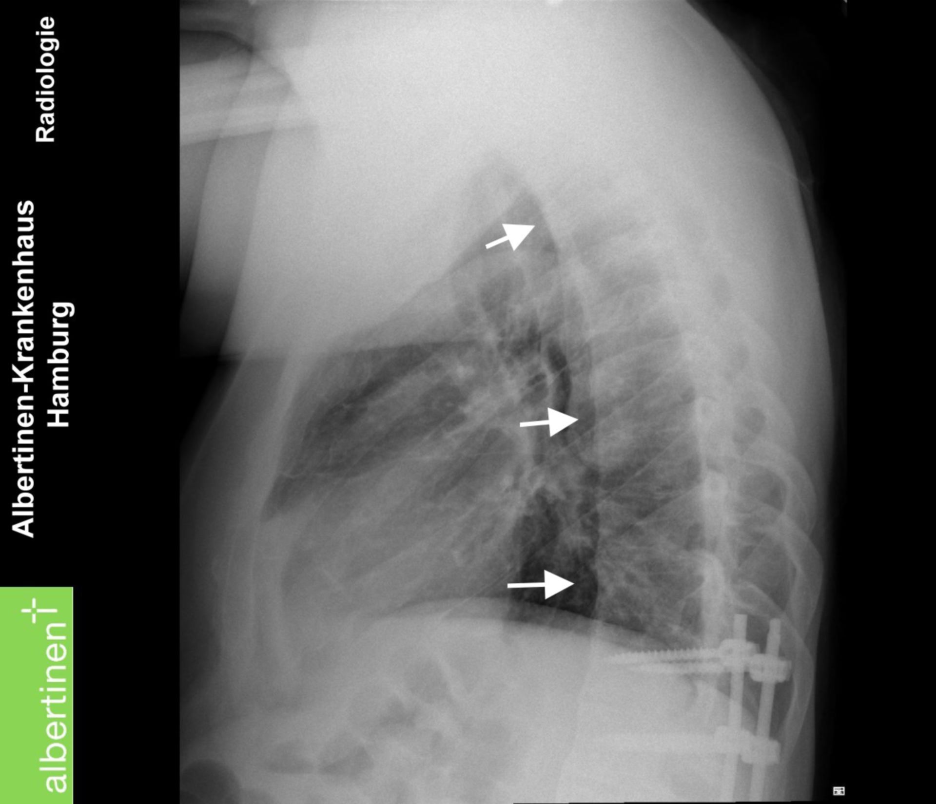 Boala Bechterew și cauzele emoționale ale ei