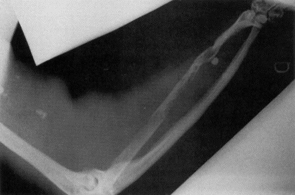 Demineralizarea corpului