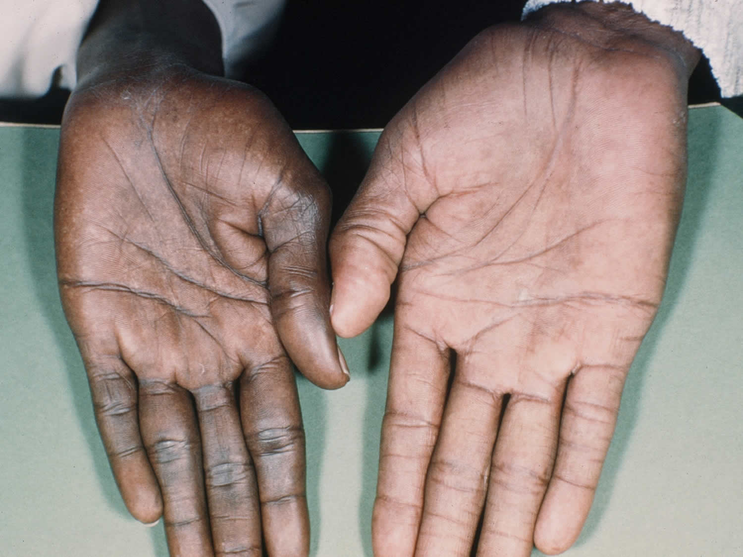 Boala lui Addison și cauzele emoționale