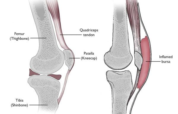 Bursita și cauzele ei emoționale