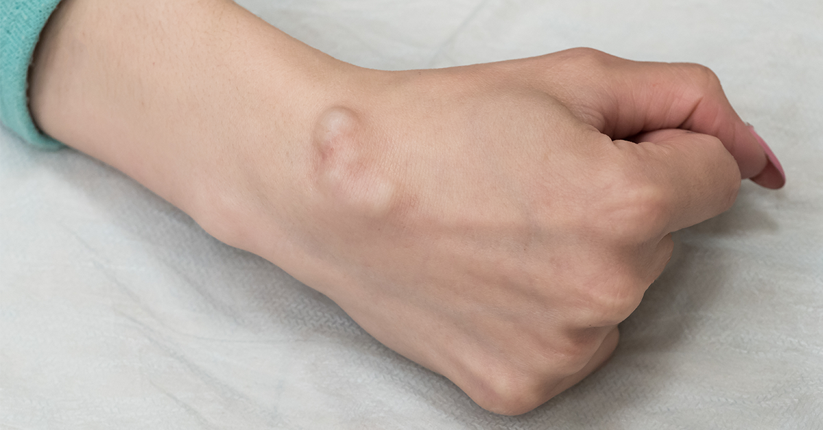 Chist. O cavitate într-un organ sau țesut