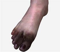 Cangrena și cauzele emoționale