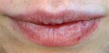 Buze uscate și crăpate. Cauza emoțională