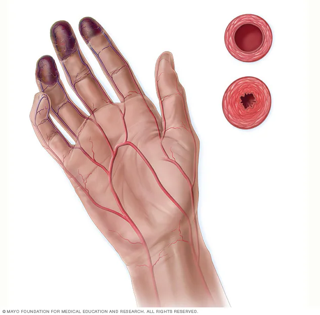 Boala cărnii tocate sau Sindromul Barbeque. Cauzele emoționale