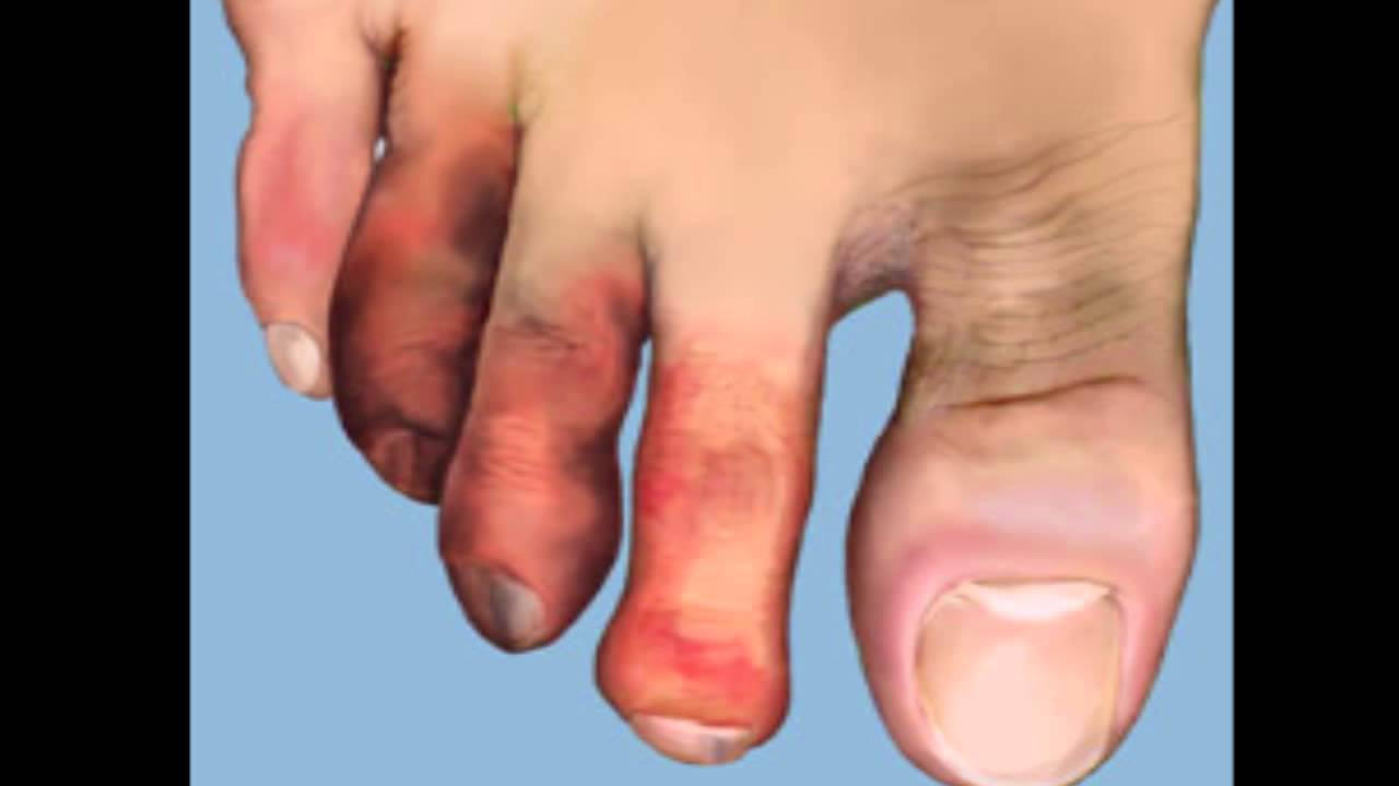 Boala lui Buerger sau tromboangeita obliterantă. Cauza emoțională