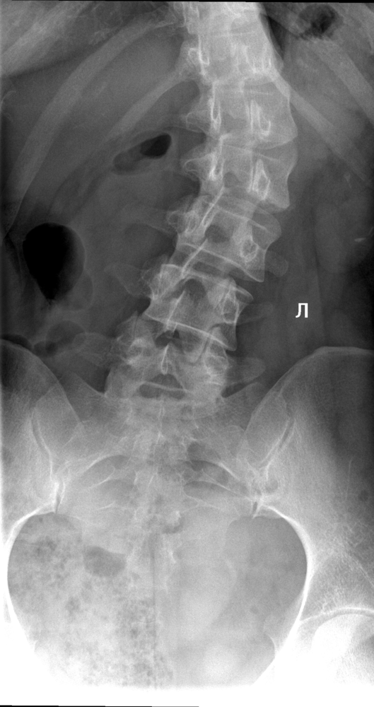 Coloana vertebrală. Scolioza