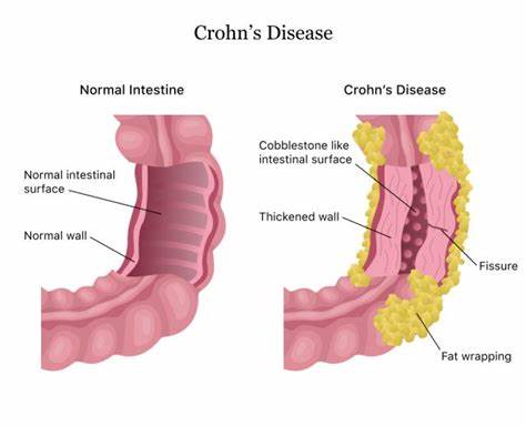 Intestine. Boala Crohn sau ileită