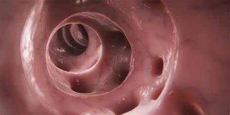 Intestine. Diverticulită