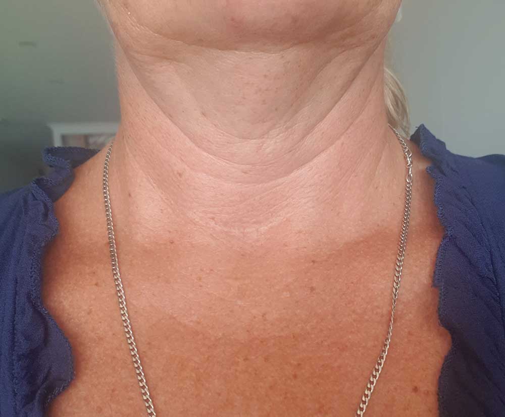 Glanda Tiroidă – Gușă