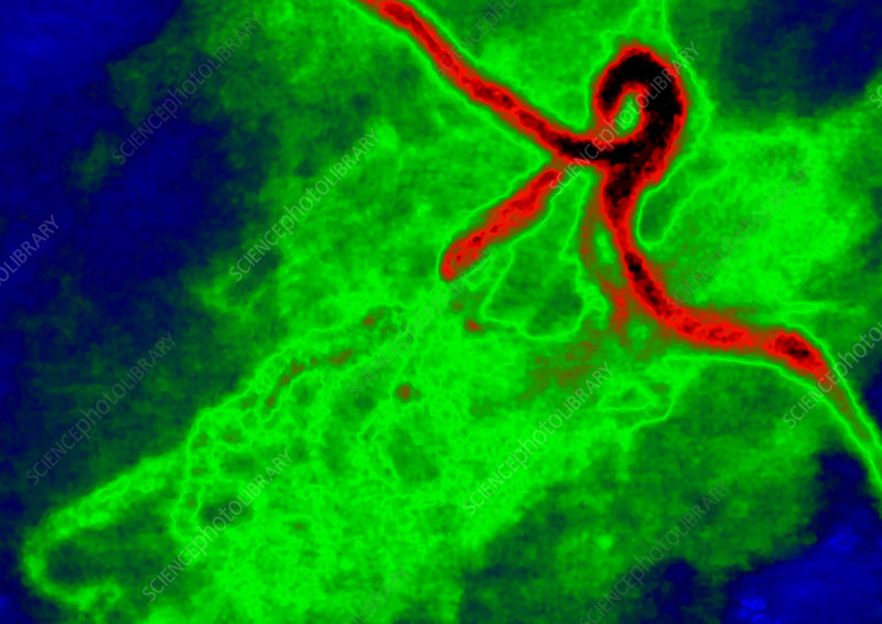 Tromboza Coronariană