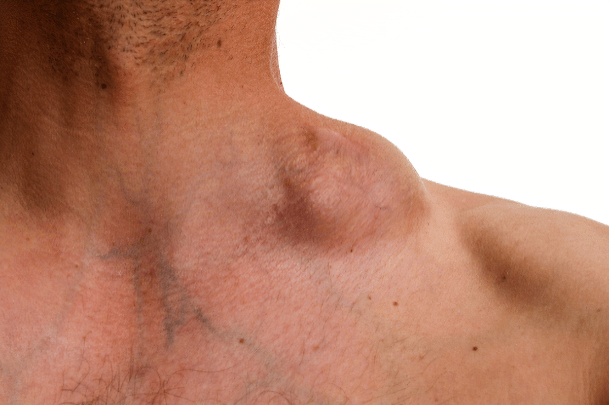 Boala lui Hodgkin sau Hodgkin’s Disease