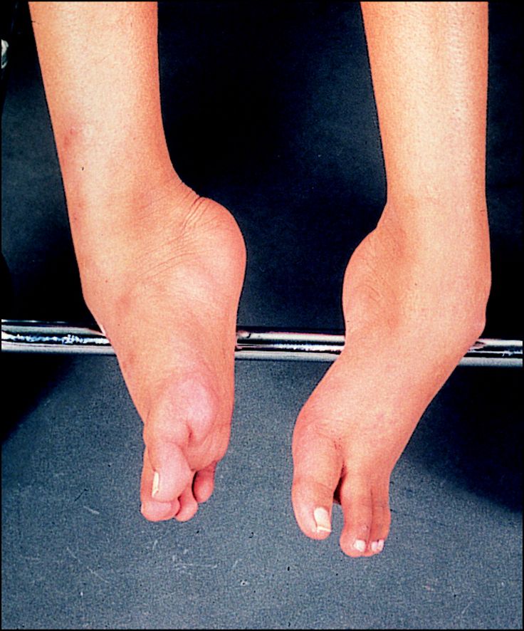 Mușchi. Distrofie musculară