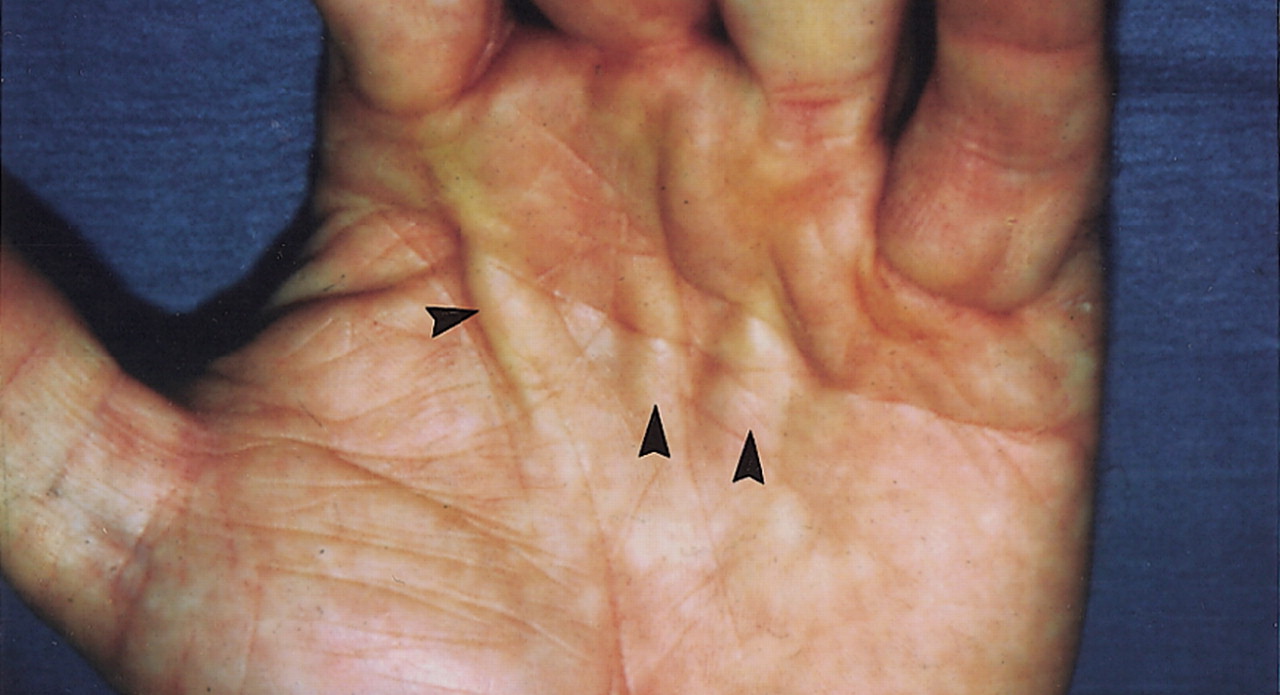 Mușchi. Fibromatoză