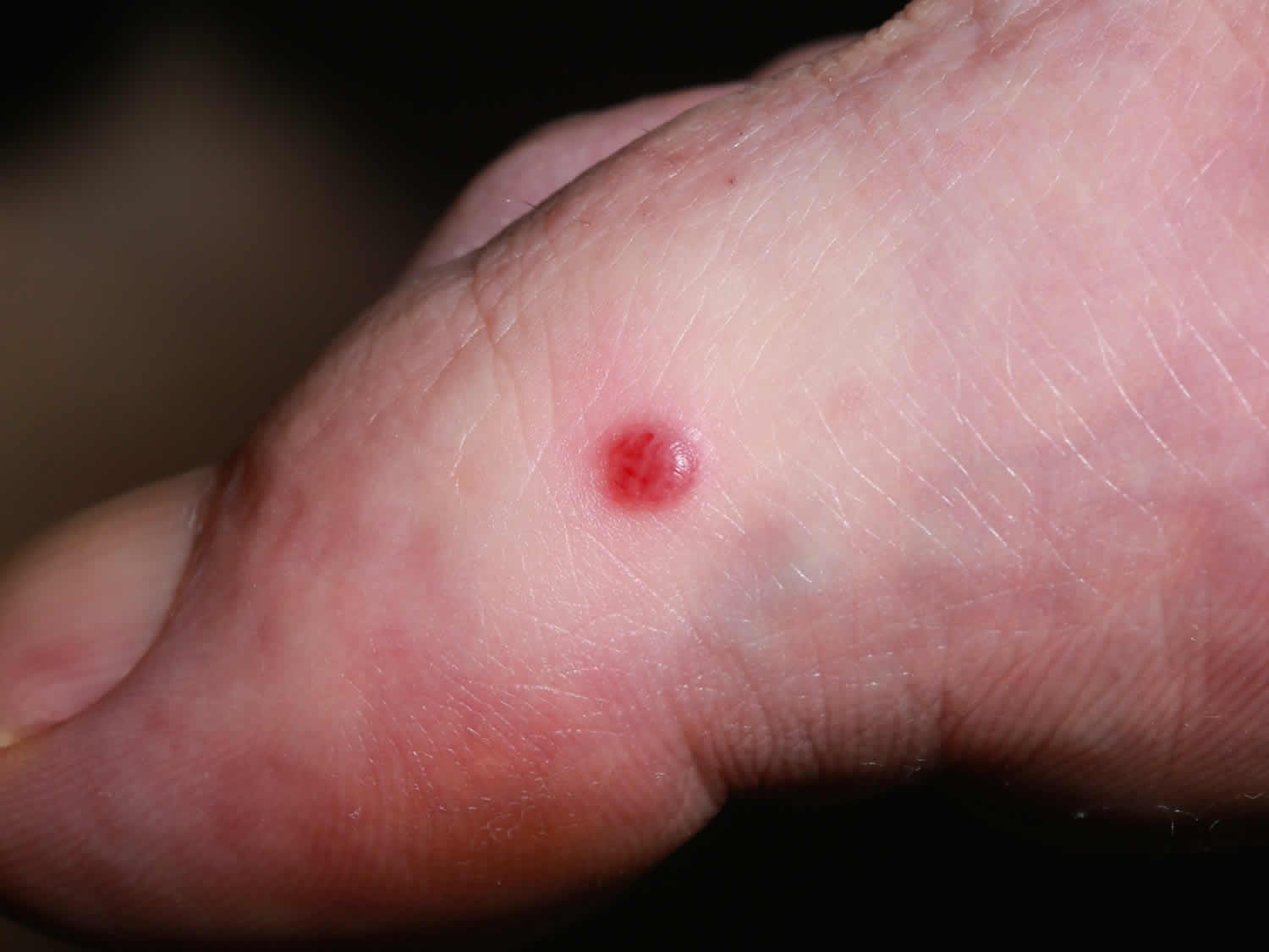 Piele. Sarcomul lui Kaposi