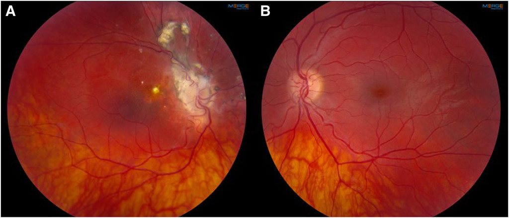 Degenerescența maculară